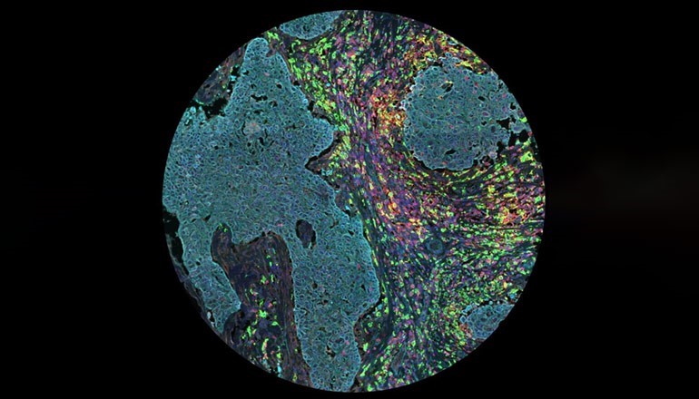 Image of breast tumours (blue) surrounded by many different cells of the immune system, including a cell known as the M2 macrophage (centre, red and yellow).