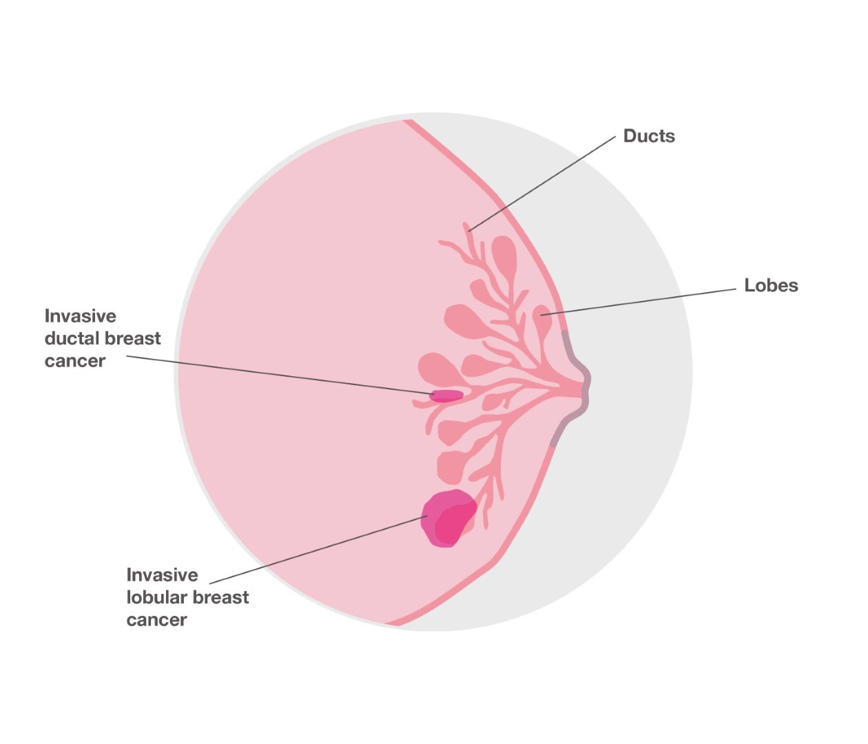 a diagram of lobular breast cancer